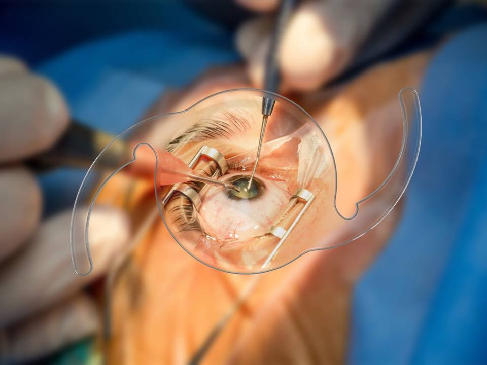 Cataract Surgery