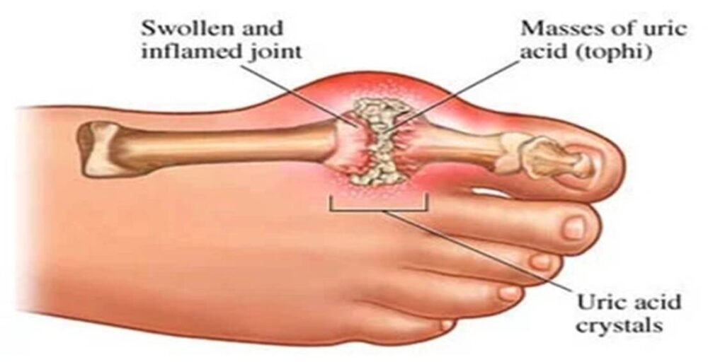 Gout attacks usually start with a sudden, severe pain in one joint, most commonly the big toe.