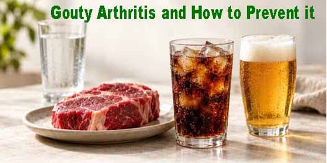 Gouty arthritis is a type of arthritis caused by the accumulation of uric acid crystals in the joints, triggering inflammation.